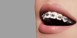 Transform Your Teeth with Dental Braces