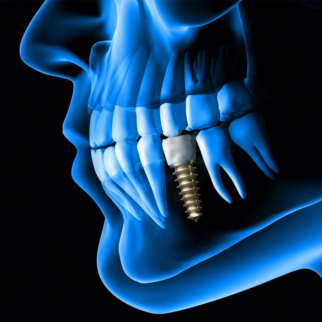 best dental implants treatment in dubai,