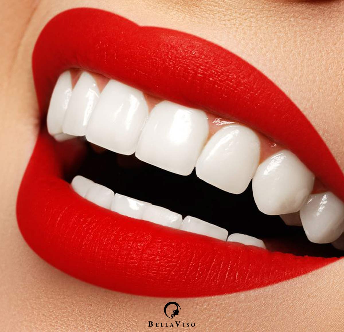 dental veneers