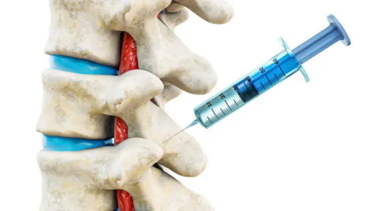 theThe image depicts an illustrated lumbar spine with a syringe injecting a substance into one of the facet joints, likely representing a medical treatment for facet joint injections at OC wellness physicians