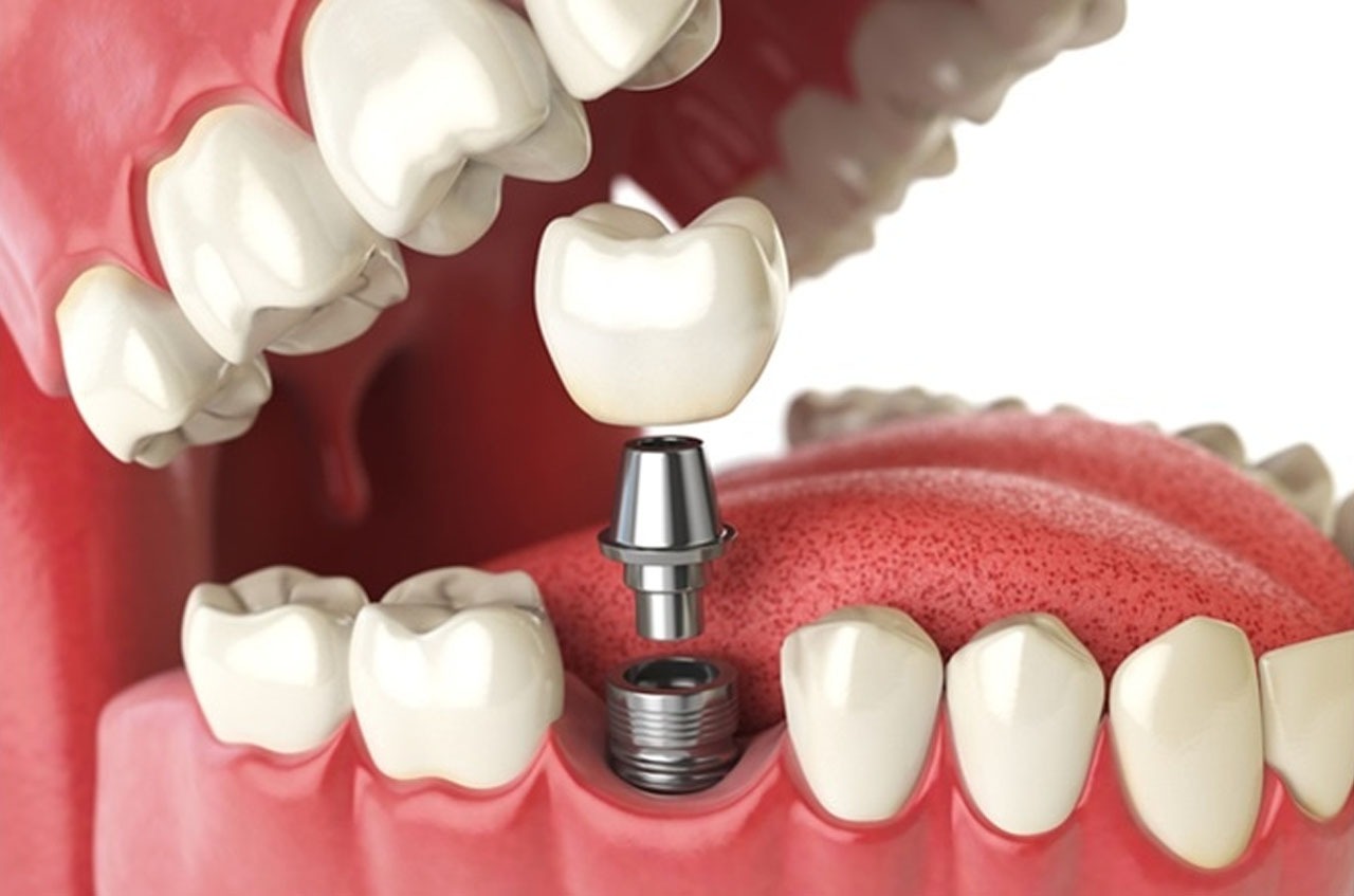 same day dental implant near me