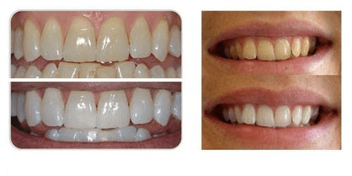 Teeth Whitening Fillings