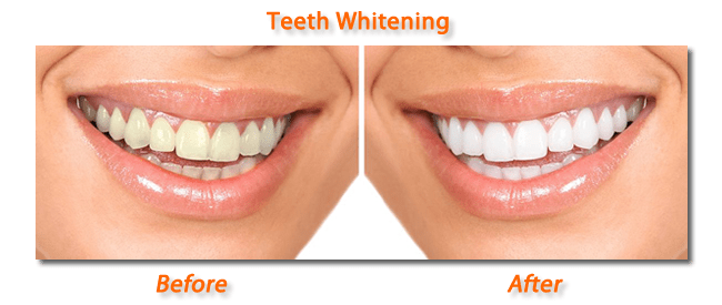 Teeth Whitening Fillings