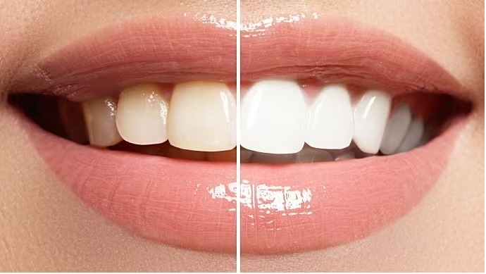 Teeth Whitening Fillings