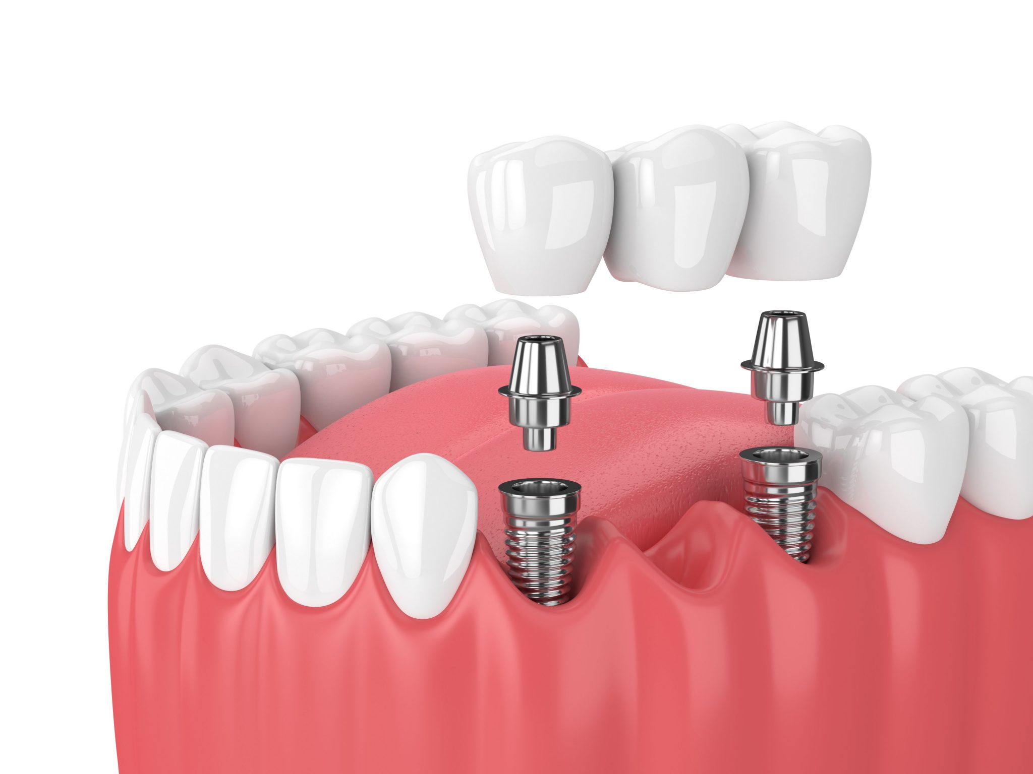 all in 4 dental implants