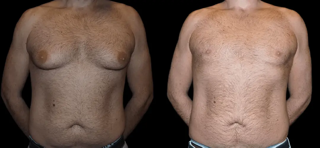 before and after male breast reduction photo